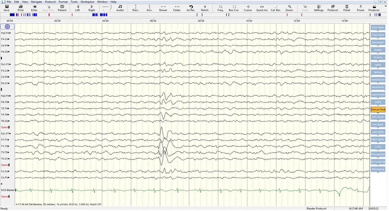 EEG and Video EEG Testing in Vadodara