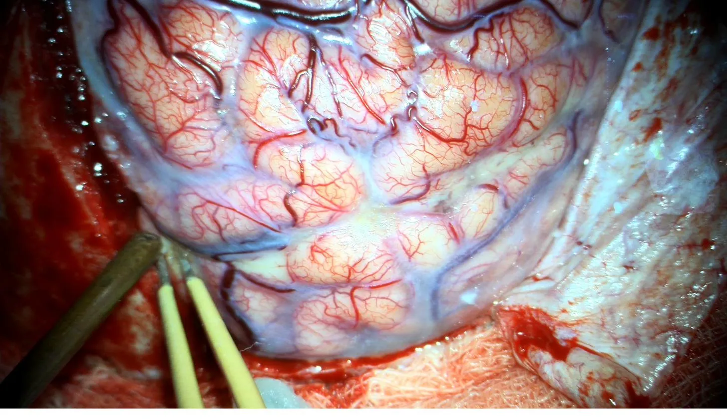 Epilepsy Treatment and Surgery Planning in Vadodara